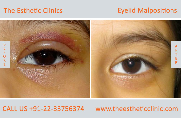Eyelid Malpostions, Ectropion Entropion Surgery before after photos in mumbai india (3)